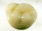 金属焼き付きポーセレン冠（メタルボンド）臼歯部