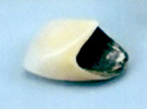 金属焼き付きポーセレン冠（メタルボンド）前歯部