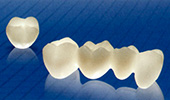ジルコニア系セラミックス（セルコンZ冠）臼歯部