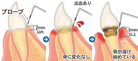 歯周ポケット検査