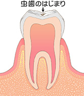虫歯C0